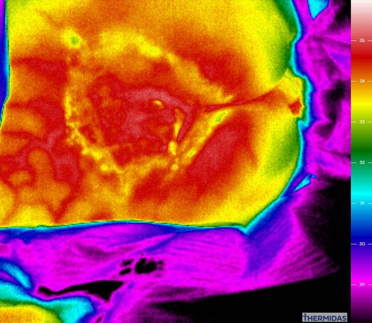 Thermografische Aufnahme eines sakralen Dekubitus und der umgebenden Haut