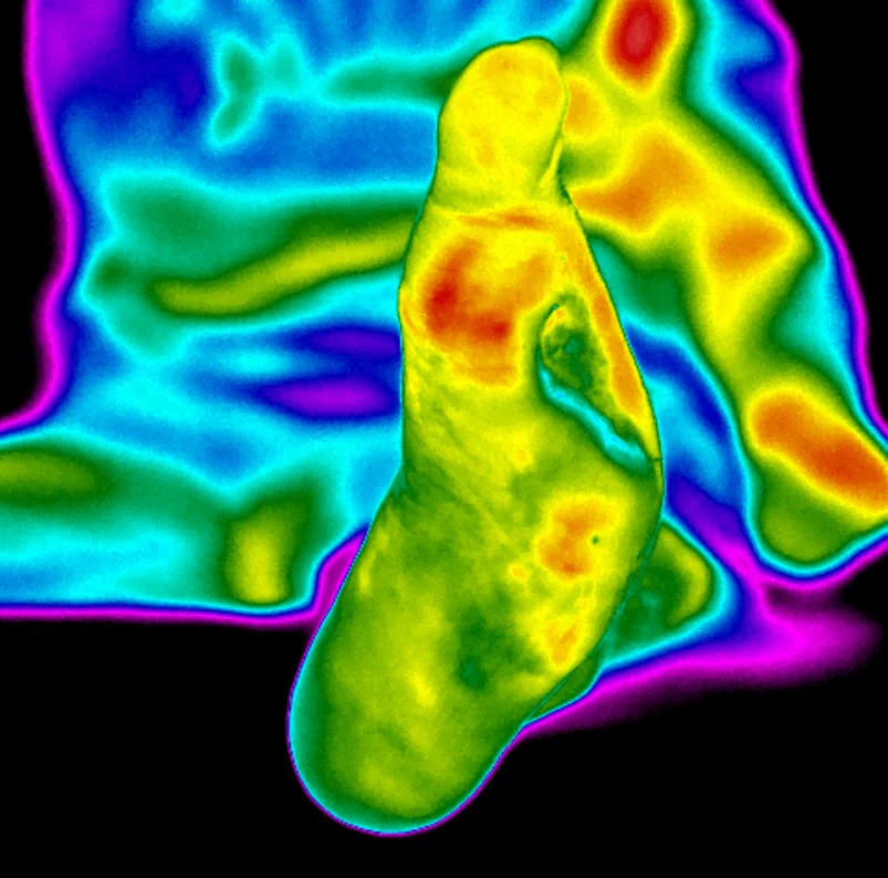 02/2023 · Wunde verschlossen: Durchblutung des Hallux wiederhergestellt