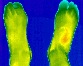 Wärmebilder der Fusssohlen und Fussrücken zum Vergleich der Temperaturverteilung